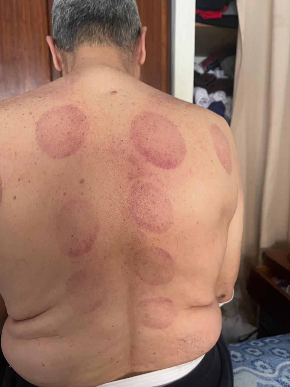 Zones ciblées de hijama