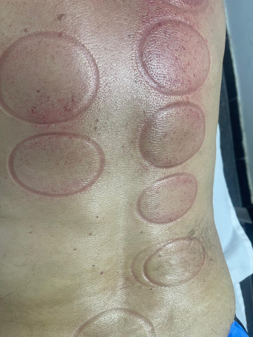 Procédure de hijama