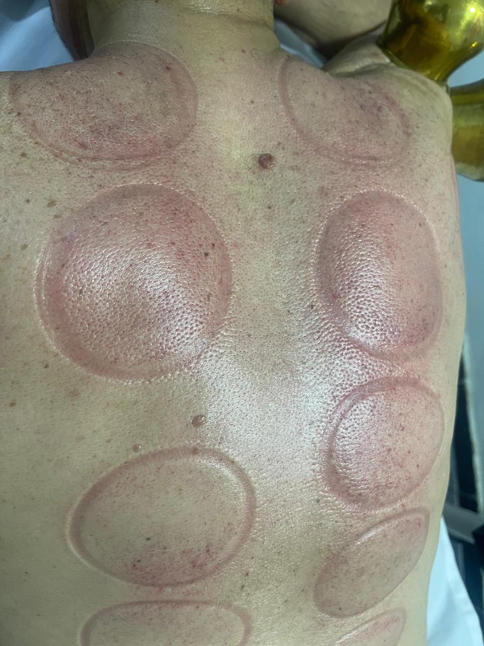 Hygiène et sécurité en hijama